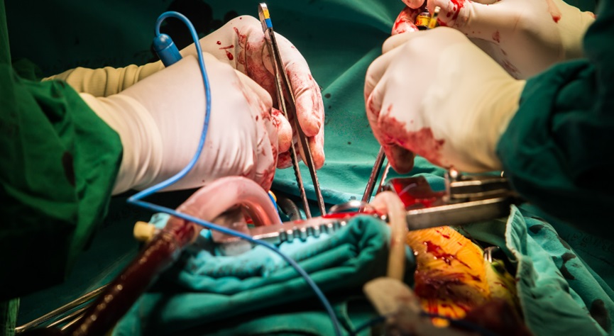 Bypass Surgery